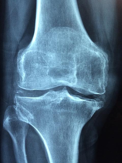 Babské rady na osteoporózu: Přirozené způsoby, jak podpořit zdraví kostí