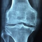 Babské rady na artrózu kolene: Přirozené způsoby, jak zmírnit artrózu